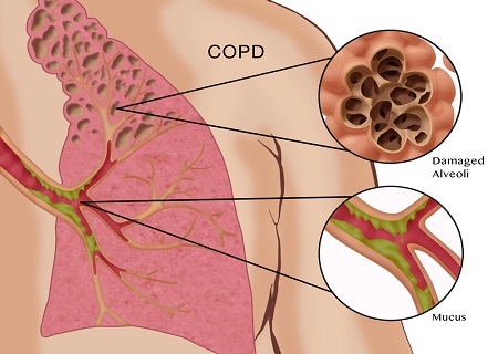 Bệnh copd